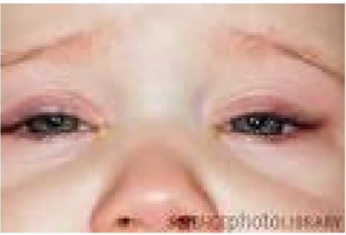 Conjunctivitis management in children