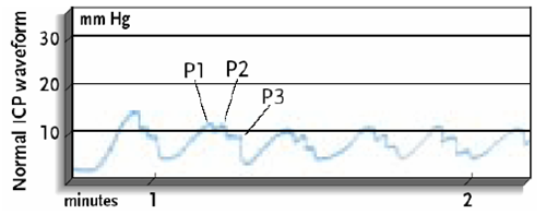 Normal ICP waveform