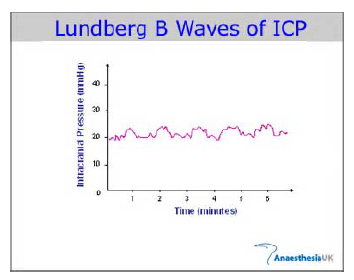 Lundberg B Waves of ICP