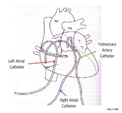 Cardiac anatomy showing pulmonary artery catheter, percutaneous central venous catheter, left atrial transthoracic catheter