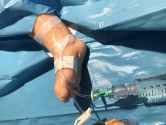 Image of Lower Limb PICC placement