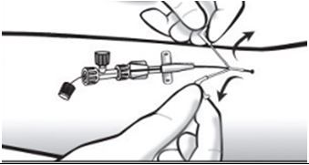 Diagram of catheter withdrawal