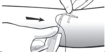 Diagram of passing the PICC line through the catheter