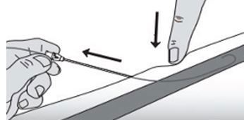 Diagram of needle or cannula withdrawal