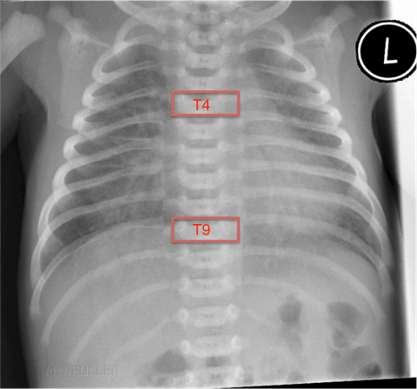 Neonatal CXR (Chest X Ray) with maximal insertion landmarks