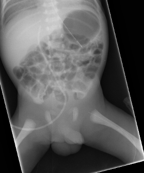 X ray of PICC line which has failed to advance beyond the hip joint