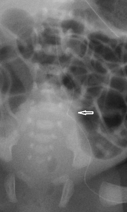 X ray of PICC line that has entered the left lumbar vein 1 of 3