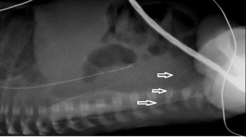 X ray of PICC line that has entered the left lumbar vein 3 of 3