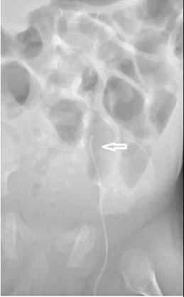 X ray of PICC line that has entered the left lumbar vein 2 of 3