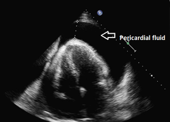Ultrasound scan of a large collection of fluid around the heart