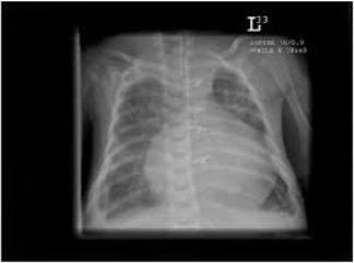 X-ray of enlarged cardiac shadow