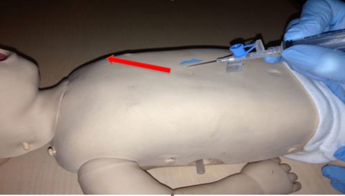 Image of approach for emergency pericardiocentesis