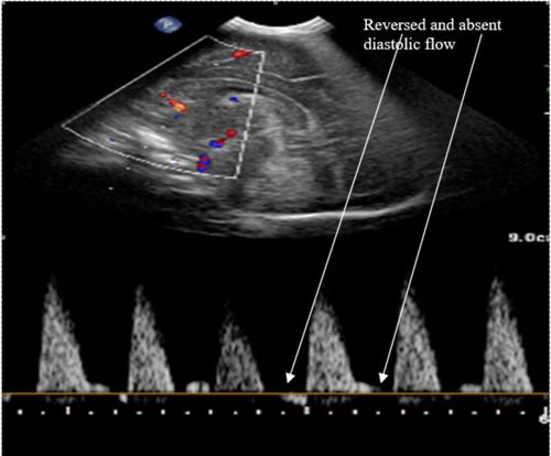 Doppler showing reversed end diastolic flow in the anterior cerebral artery.