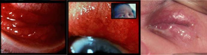 Images of eyes with infection