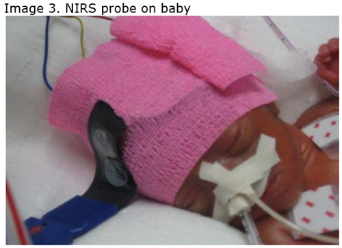 Image 3. NIRS probe on baby